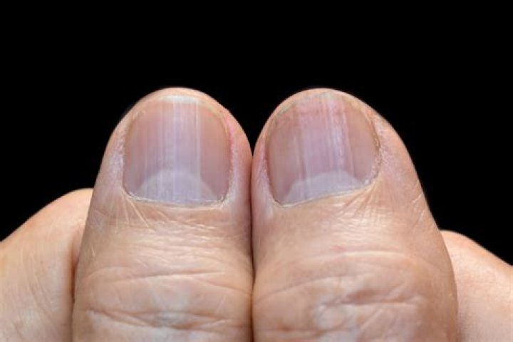 Do nails hurt oak trees?