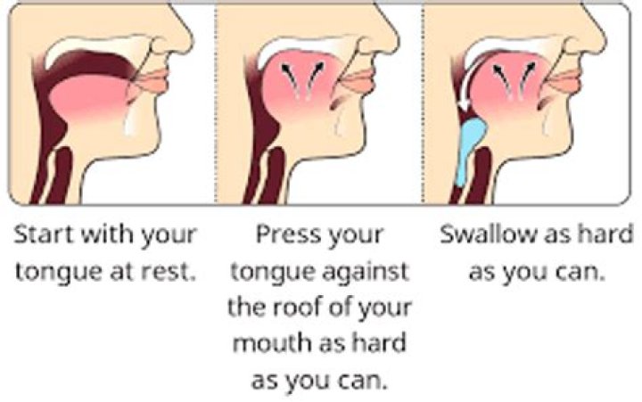 Does pressing your tongue to the roof of your mouth stop brain freeze?