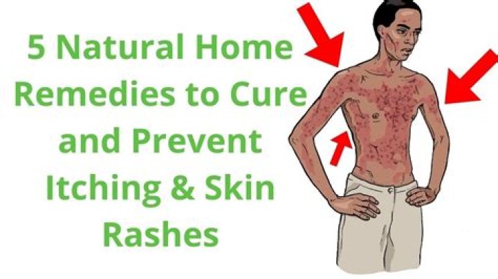 How do you cure really bad itching?