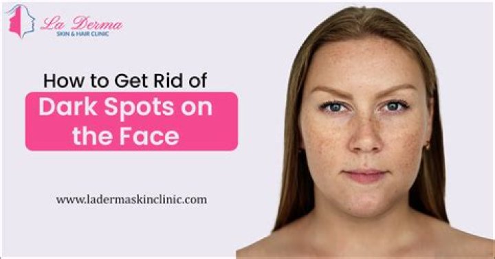 How do you get rid of runners face?