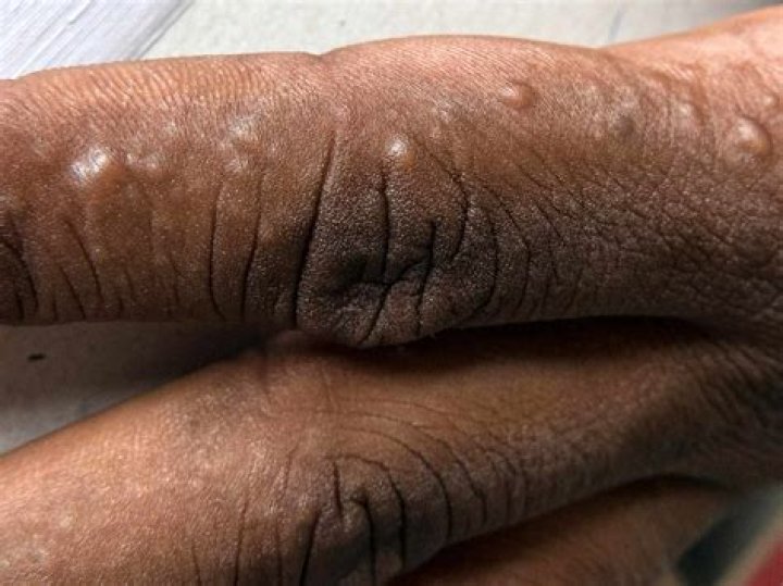 How do you treat black spots on palms?