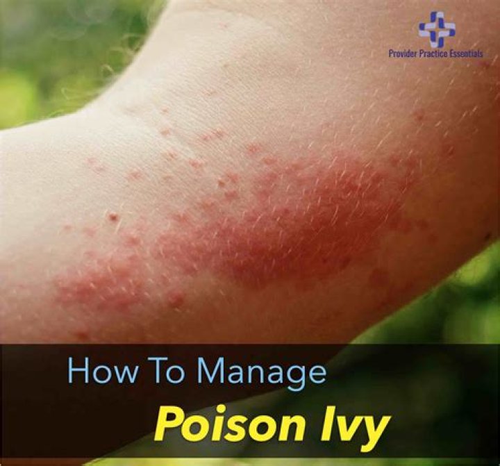How long does poison ivy rash last?