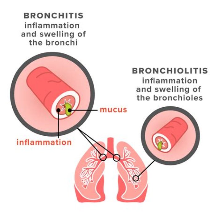 Is cheese bad for bronchitis?