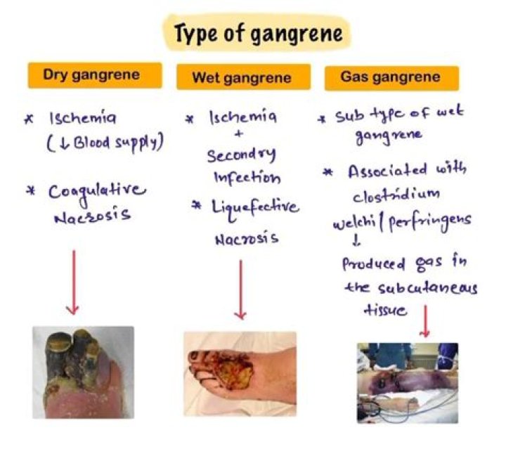 Is gangrene still a thing?
