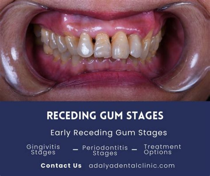 Is it normal for gums to recede little?