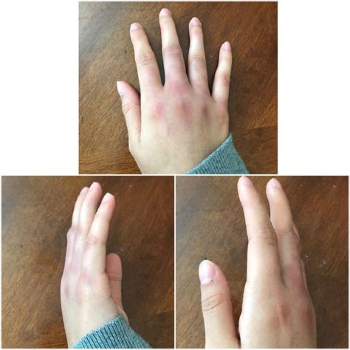 Is my knuckle broken or just bruised?