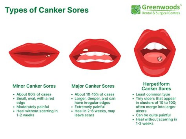 What are the three types of canker sores?