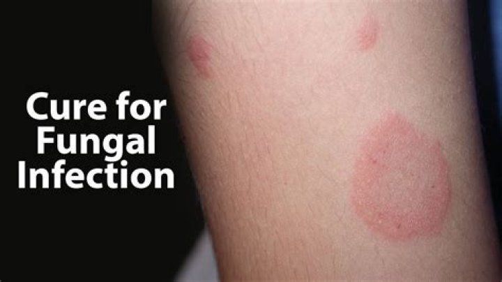 What does a fungal infection on the skin look like?
