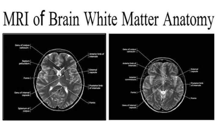 What does it mean when you have white matter on a brain MRI?