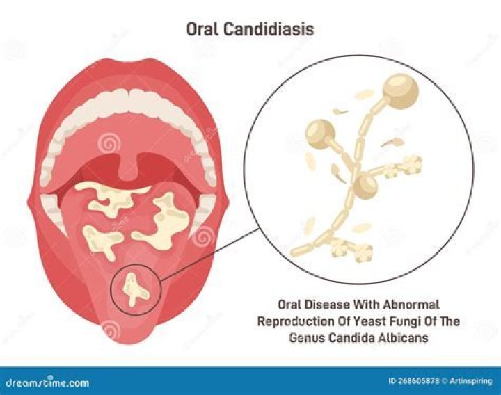 What is the difference between Candida and yeast infection?