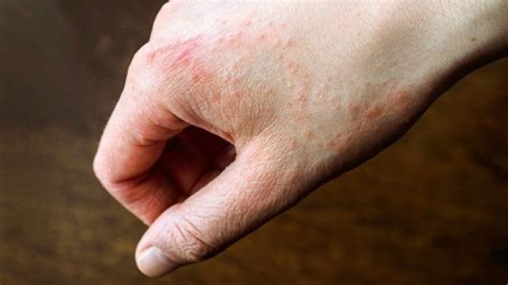 Which disease begins as a rash with small red bumps?