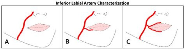 Which is larger the inferior labial artery or the facial artery?